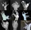 x-rays-of-fireworks-related-injuries-v0-3t7rlxxm619a1.webp