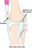 mcl_sprain_2_lg.jpg